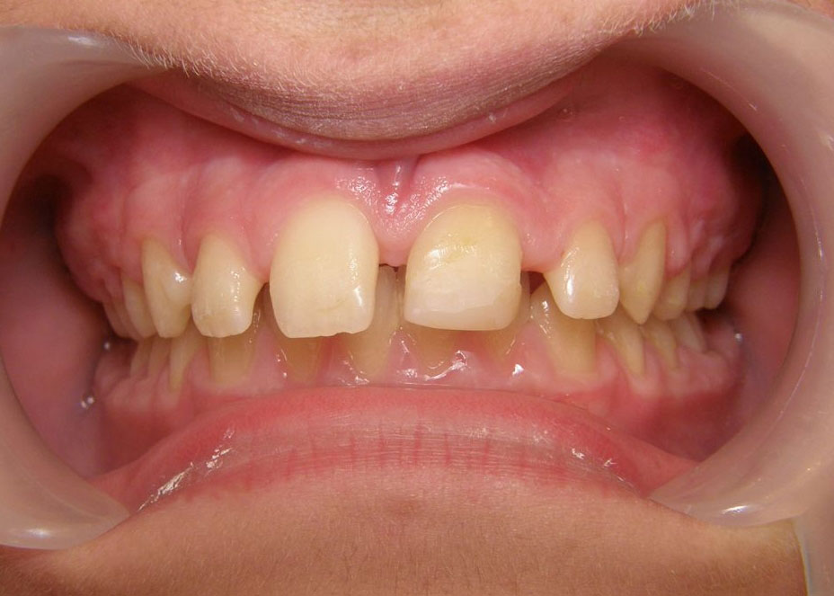 orthodontiste_geneve_avant_apres